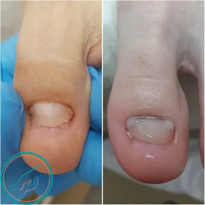 Причины покраснения и опухоли на большом пальце возле ногтя