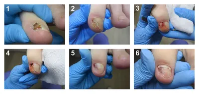 Случай из практики – подногтевая бородавка ✓ Авторские статьи Клиники  подологии Полёт в Москве