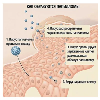 Удаление папиллом | СевКлиник - медицинский центр| Севастополь