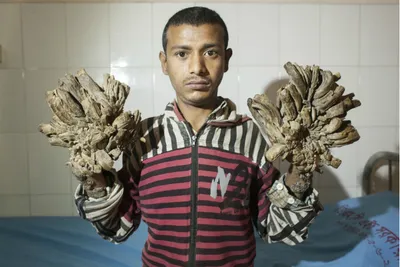 Что творят бородавки: Человеку-дереву из Бангладеш сделают операцию - KP.RU
