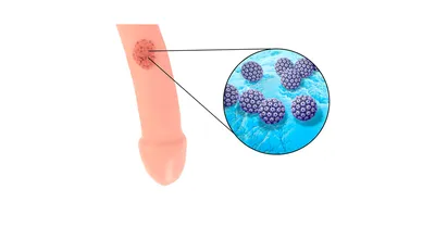 Бородавки на члене: причины, симптомы, лечение