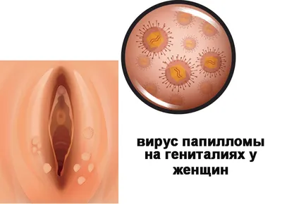 Папилломы на гениталиях - как вести половую жизнь с ВПЧ? | Лазерсвiт в  Одессе