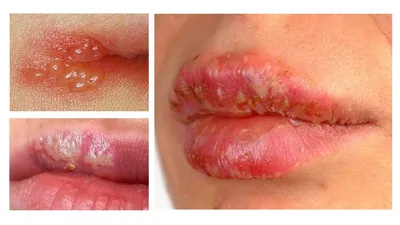 Что такое лабиальный герпес - причины появления и лечение герпеса  (простуды) на губах | Аллокин-Альфа