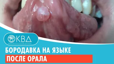 👅 Бородавка на языке после орала. Клинический случай №932 - YouTube