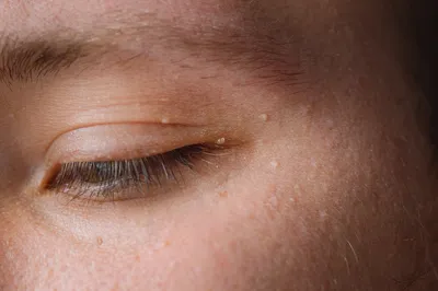 Папиллома на лице | Asthetiklab