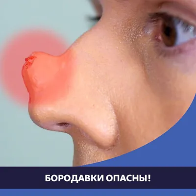 Фотоэпиляция ПМР - Классические плоские папилломы на лице. Это не родинки,  а кожные образования связанные с вирусом человеческой папилломы. Они легко  удаляются. | Facebook