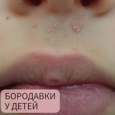 Классические плоские папилломы на лице. Это не родинки, а кожные  образования связанные с вирусом человеческой папилломы. Они легко… |  Instagram