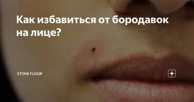 Плоские или юношеские бородавки - лечение плоской бородавки | Лазерсвiт в  Одессе