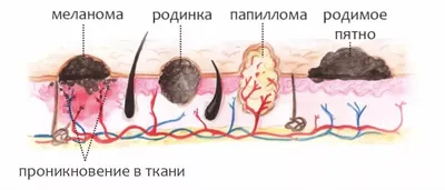 Как удалить бородавки в домашних условиях простыми средствами - МК