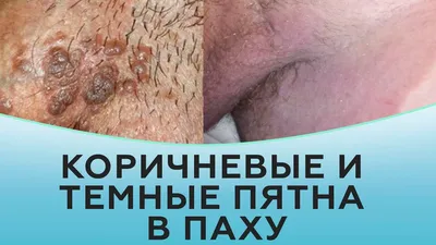 Почему появляются папилломы и как избавиться от папиллом на теле? |  Лазерсвiт в Одессе