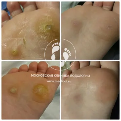 Лечение бородавок на ногах, на стопе | Московская Клиника Подологии