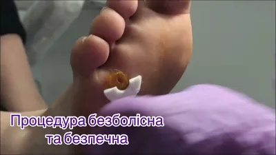 Подошвеннные бородавки на ногах, фото, лечение, удаление в Днепропетровске  Украина