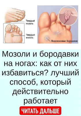 Бородавки у детей: лечение и удаление. Как вывести бородавки у ребенка.