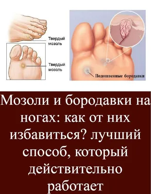 Бородавки у детей: на руках, пальце, ноге | Лечение / удаление бородавок в  Москве ✓ Клиника подологии Полёт