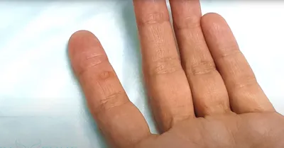 Палец бородавки на руках, конец, медицинская концепция Стоковое Фото -  изображение насчитывающей заболевание, бородавочка: 169510552