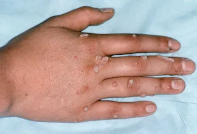 Gainmiga Dushanbe - Бородавки — это эпителиальные разрастания после вредной  деятельности вируса папилломы человека (ВПЧ). Чаще всего бородавки  располагаются на пальцах рук, на ногах в области стопы, на лице. Выглядят,  как наросты,
