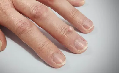 Классическая папиллома на пальцах рук-... - Фотоэпиляция ПМР | Facebook