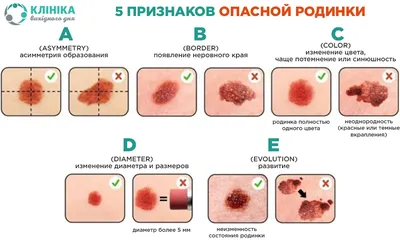 Почему появляются папилломы и как избавиться от папиллом на теле? |  Лазерсвiт в Одессе