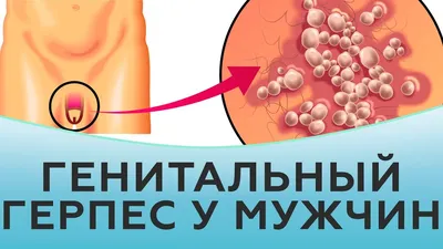 Бородавка – причины, симптомы, признаки, диагностика и лечение | «Будь  Здоров»