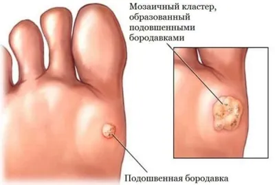 Бородавки подошвенные.... - Академия подологии Конева | Facebook