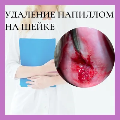 ВПЧ: симптомы, причины, диагностика и лечение вируса папилломы человека в  Москве - сеть клиник «Ниармедик»