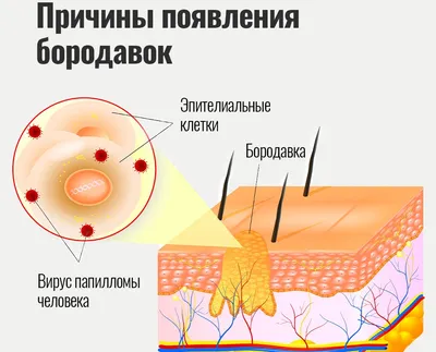 Лечение бородавок в Киеве — Derma.ua