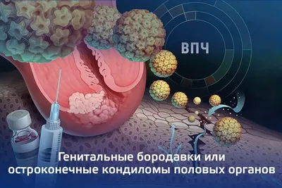 Папилломы: виды, проявления, удаленние и особенности лечения у мужчин и  женщин