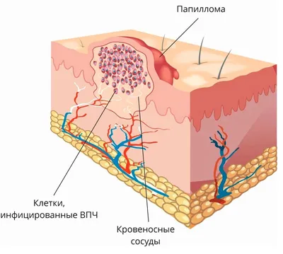 Удаление бородавок лазером в Киеве. Цены, Результаты