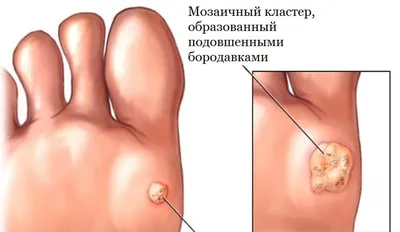 Лечение бородавок