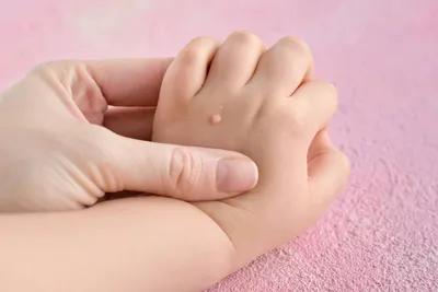 Бородавка между пальцами ног - причины, методы лечения.