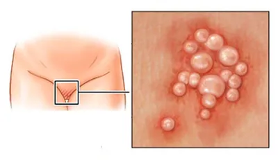 Лечение остроконечных кондилом в Киеве — Derma.ua