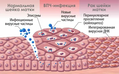 Папилломы: виды, проявления, удаленние и особенности лечения у мужчин и  женщин