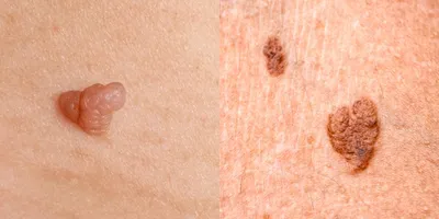 Гранулы фордайса на губах, фото до и после, удаление в клинике Medicris