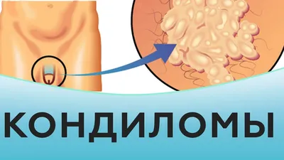 Папилломы и бородавки: удалять или нет? | Энергия здоровья | Дзен