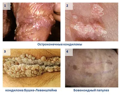 Что такое ВПЧ? Вирус папилломы человека | Врач дерматовенеролог, трихолог  Фоменко Лариса Викторовна