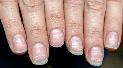 20 причин, по которым у вас на ногтях могут быть продольные полосы или  бороздки - Рамблер/новости