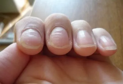 Белые точки и полоски на ногтях