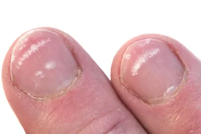 Ожог ногтевой платины | Онихолизис после ожога ногтя - как восстановить  ногтевую пластину | Советы nail-мастера - Фото