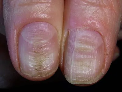 Почему бороздки на ногтях могут внезапно стать более заметными: эксперт  назвал основные причины и способы решения проблемы