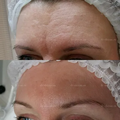 Фото до и после инъекционной косметологии и уход