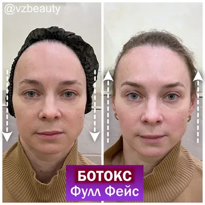 Ботокс от морщин – фотографии до и после