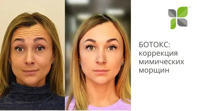 Ботокс Фулл фейс (full face) — что это такое и какие результаты можно  получить — vzbeauty.ru