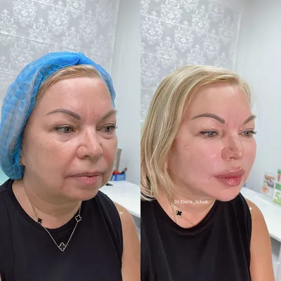 Ботокс до и после, фото губ после уколов Botox