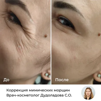 Лифтинг (подтяжка) Нефертити ботоксом: цены в Москве | Уколы ботокса в  нижнюю треть лица в клинике BeautyWay Clinic