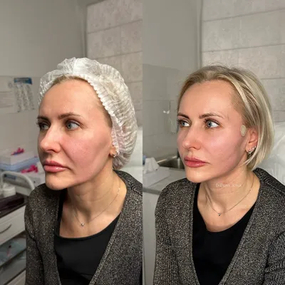 Ботокс Фулл фейс (full face) — что это такое и какие результаты можно  получить — vzbeauty.ru