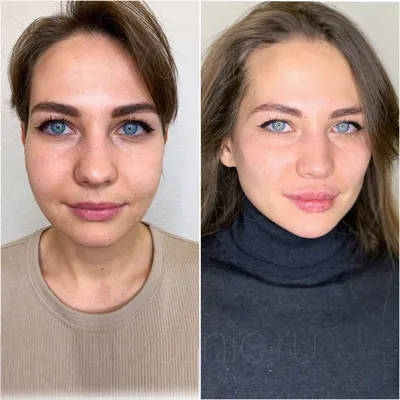 Косметолог показала, как инъекции ботокса меняют лицо: фото до и после |  DOCTORPITER