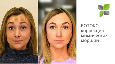 Ботулинотерапия в Москве: цены, фото до и после, отзывы | Стоимость  ботулинотерапии лица в клинике Seline