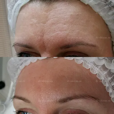 Уколы Ботокса (Botox)