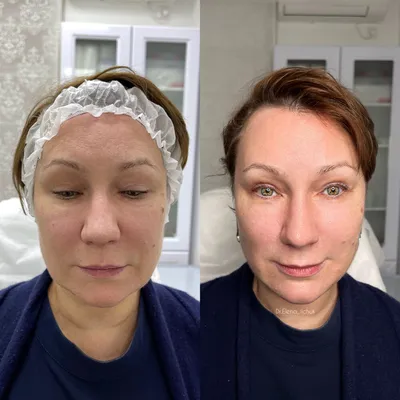 Ботокс для лица - цена в Санкт-Петербурге на инъекции и уколы Botox