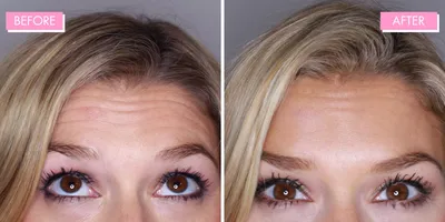 Let Botox help you turn back the clock in 5 age-revealing areas | Center  for Surgical Dermatology